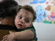 جدري الماء ينهش أجساد الأطفال في خيام النزوح